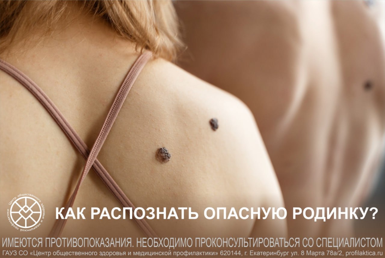 Как распознать опасные родинки?